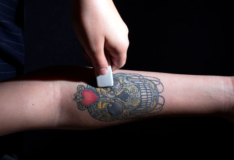 ¿Posees un tatuaje indeseado? Enlighten de Cutera llegó para solucionar tus problemas estéticos