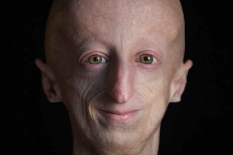 ¿Qué es la progeria? la rara enfermedad que tenía el italiano Sammy Basso